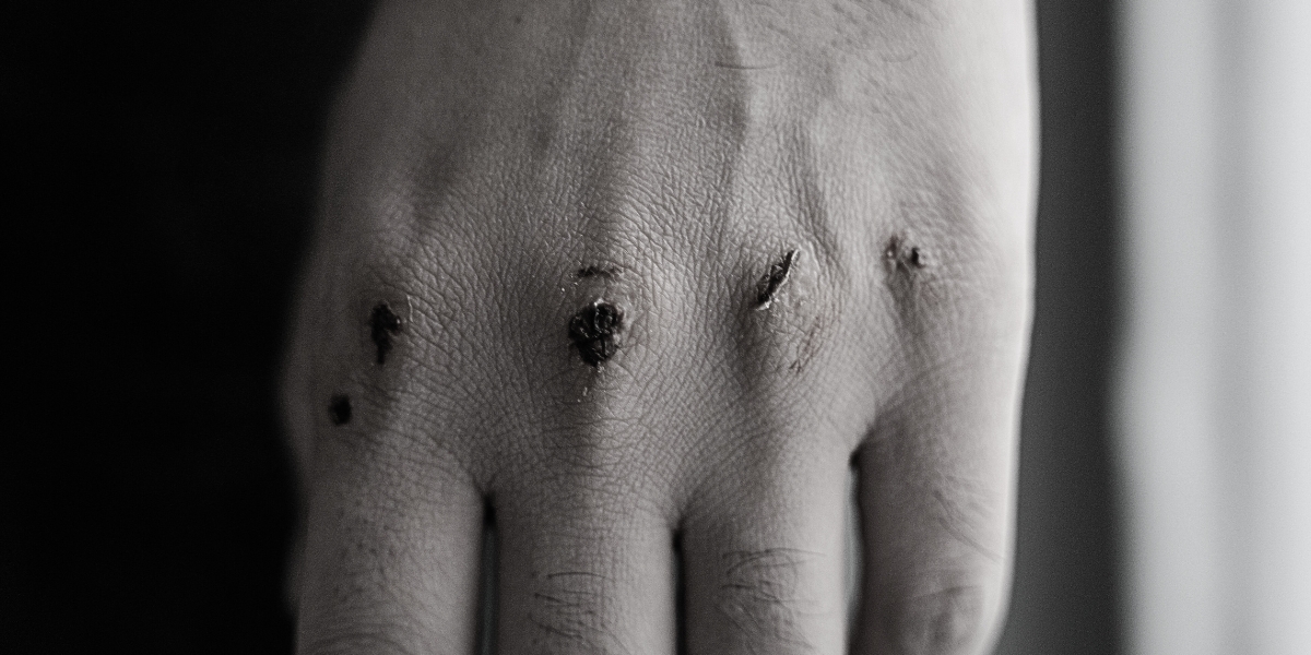 Como evitar lesões cutâneas em esportes de contato