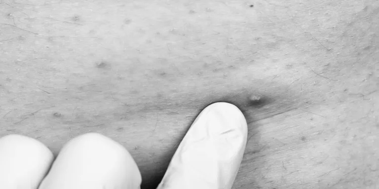 Leia mais sobre o artigo Foliculite no esporte: como evitar e tratar a inflamação dos folículos pilosos