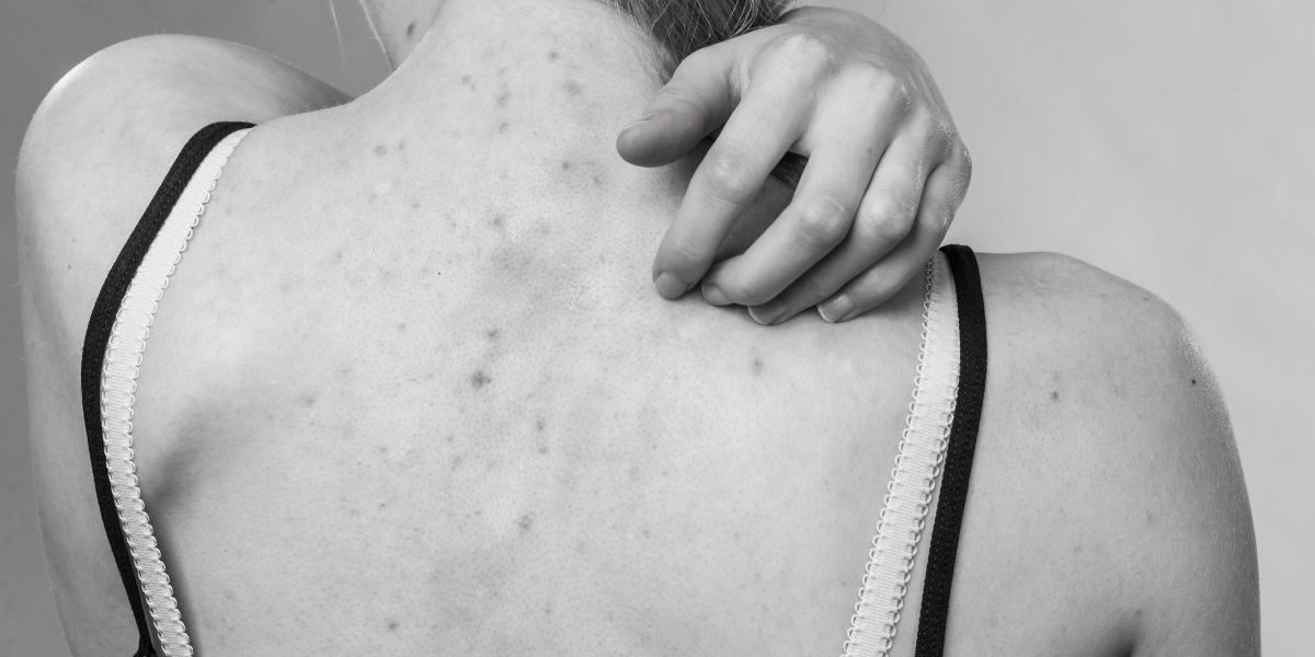 Acne e Atividade Física: O Suor Pós-Exercícios aumenta a produção de acne?