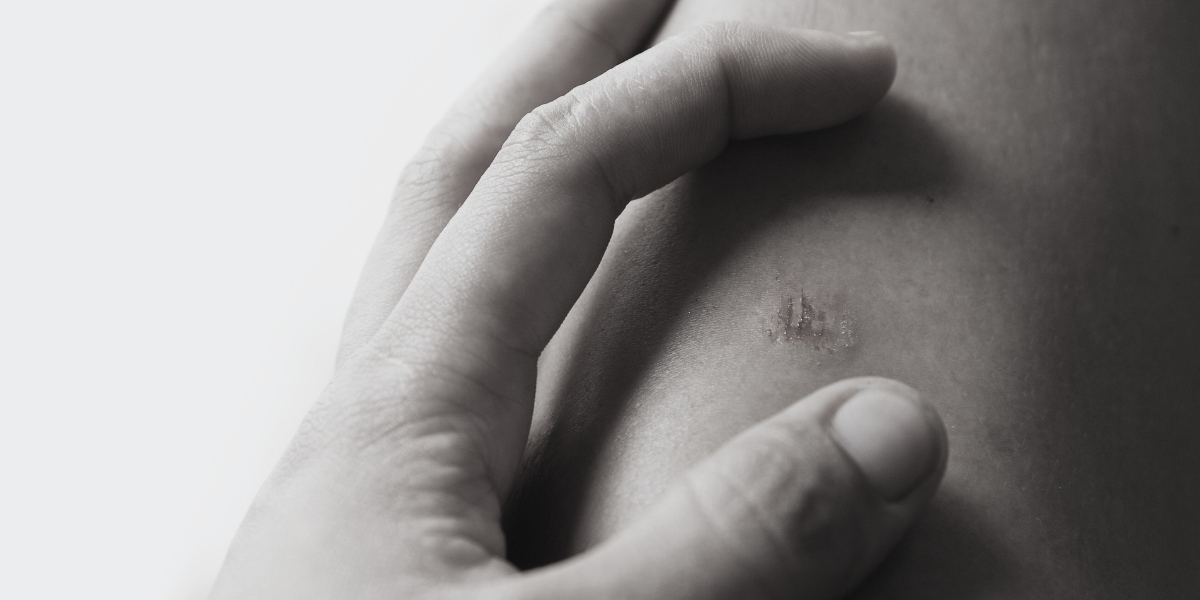 Feridas que não cicatrizam: o que pode ser e como tratar?    